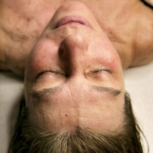 Tratamiento con probióticos vivos